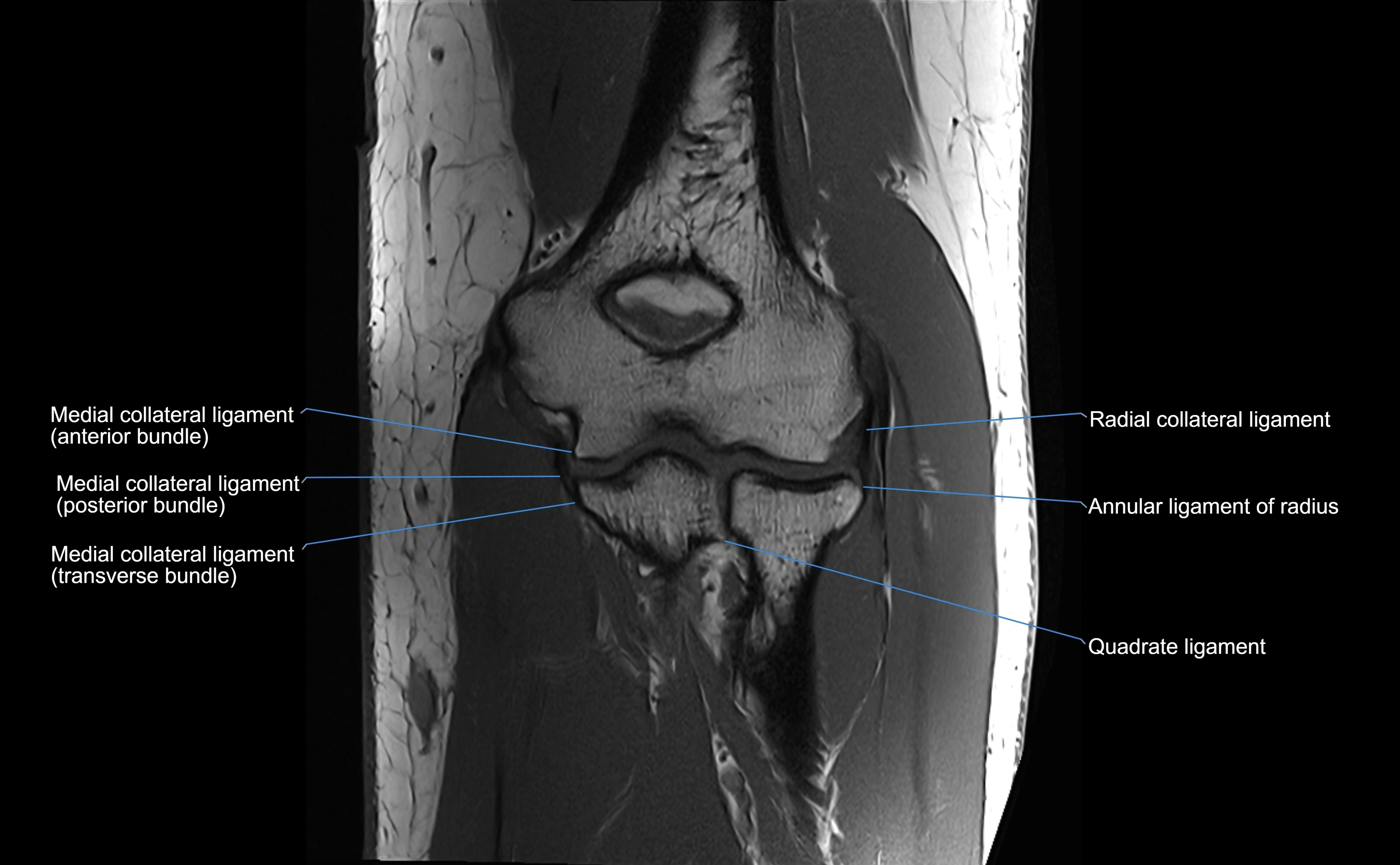 MRI elbow ligaments coronal cross sectional anatomy 3T  radiology  image-img-07001-00021.webp